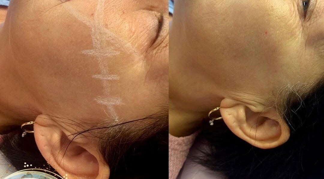 Before and after facelift at Aquarius Artistry and Aesthetics, Springside, Scotland, GB showcasing remarkable results.