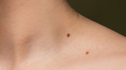 Chatham Foot Care Clinic and Skin Tag Removal image 3