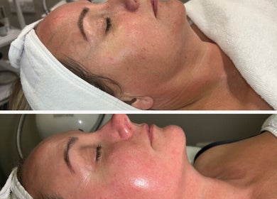 Facial treatment before and after at Beauty at No.28, Blandford Forum, England, GB.