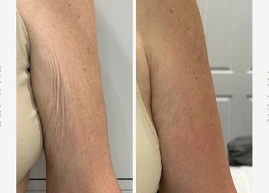 Before and after arm rejuvenation at Beauty at No.28, Blandford Forum, England, GB showing smoother skin.