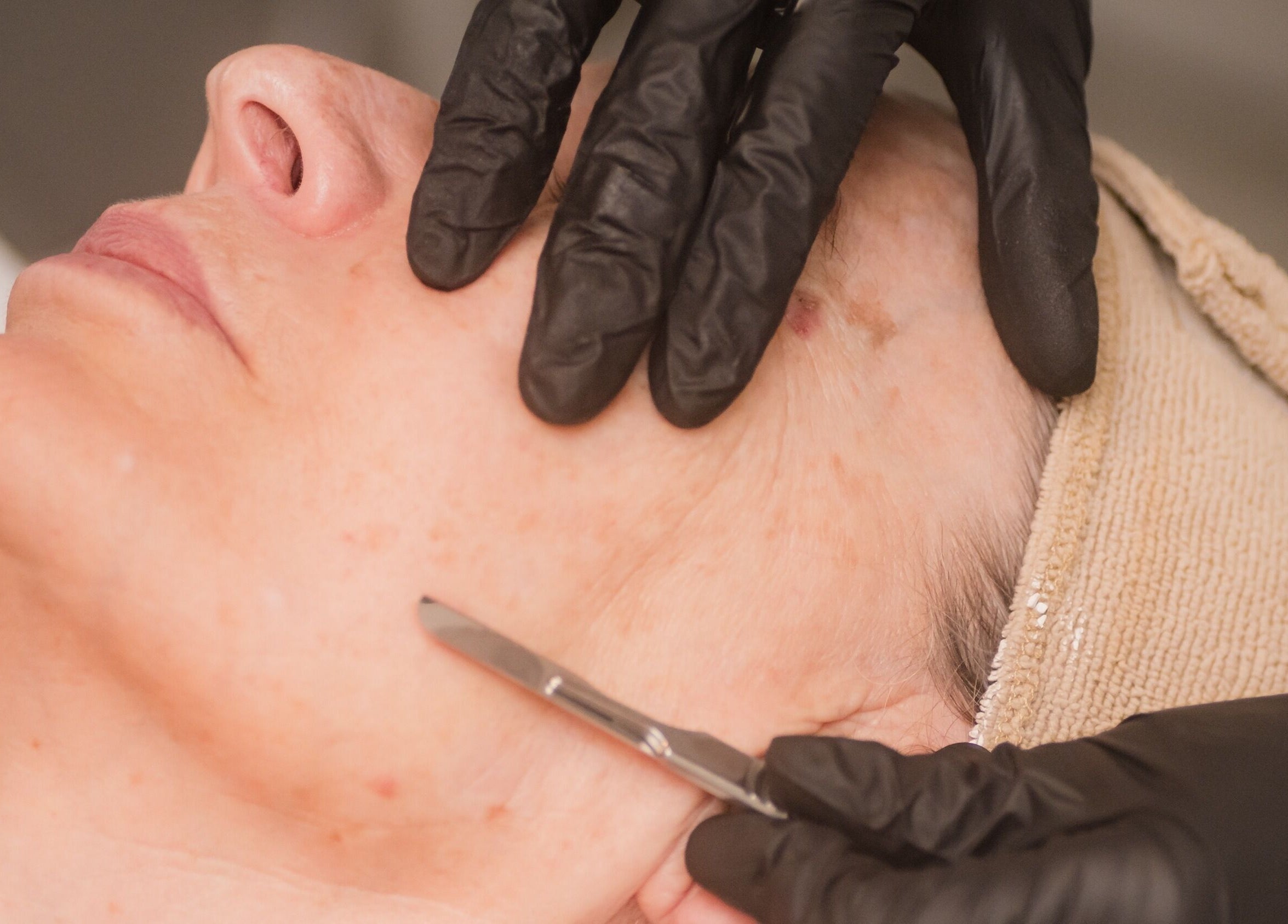 Dermaplaning treatment at Sublime Skin and Body, Cape Town, Western Cape, ZA, showcasing expert care.