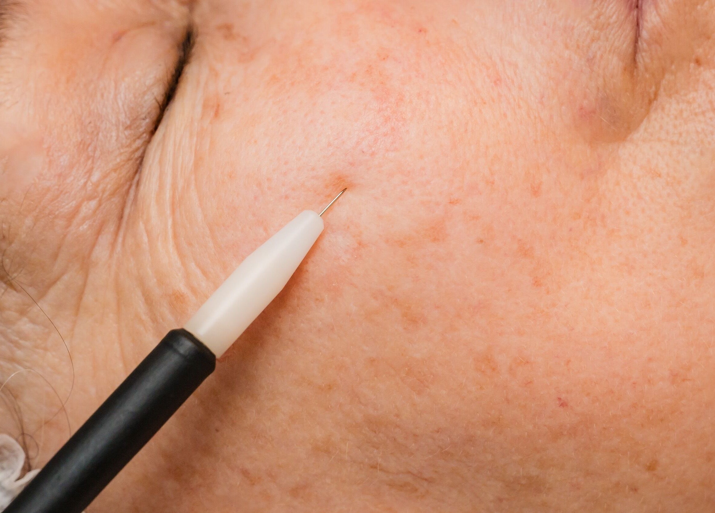 Close-up of a skin treatment procedure at Sublime Skin and Body, Cape Town, Western Cape, ZA.