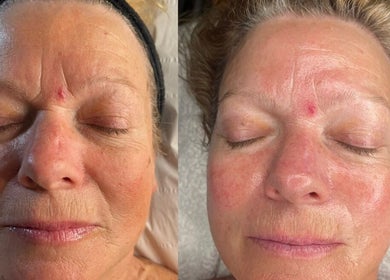 Before and after facial treatment at E.R Holistic Beauty in Southwell, England, GB.