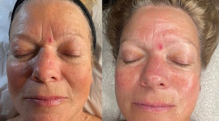 Before and after facial treatment at E.R Holistic Beauty in Southwell, England, GB.