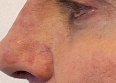 Close-up of nose post-treatment at Oxley Aesthetics in Hemel Hempstead, England, GB.