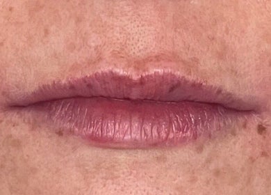 Detailed lip enhancement at Oxley Aesthetics in Hemel Hempstead, England, GB for a fuller look.