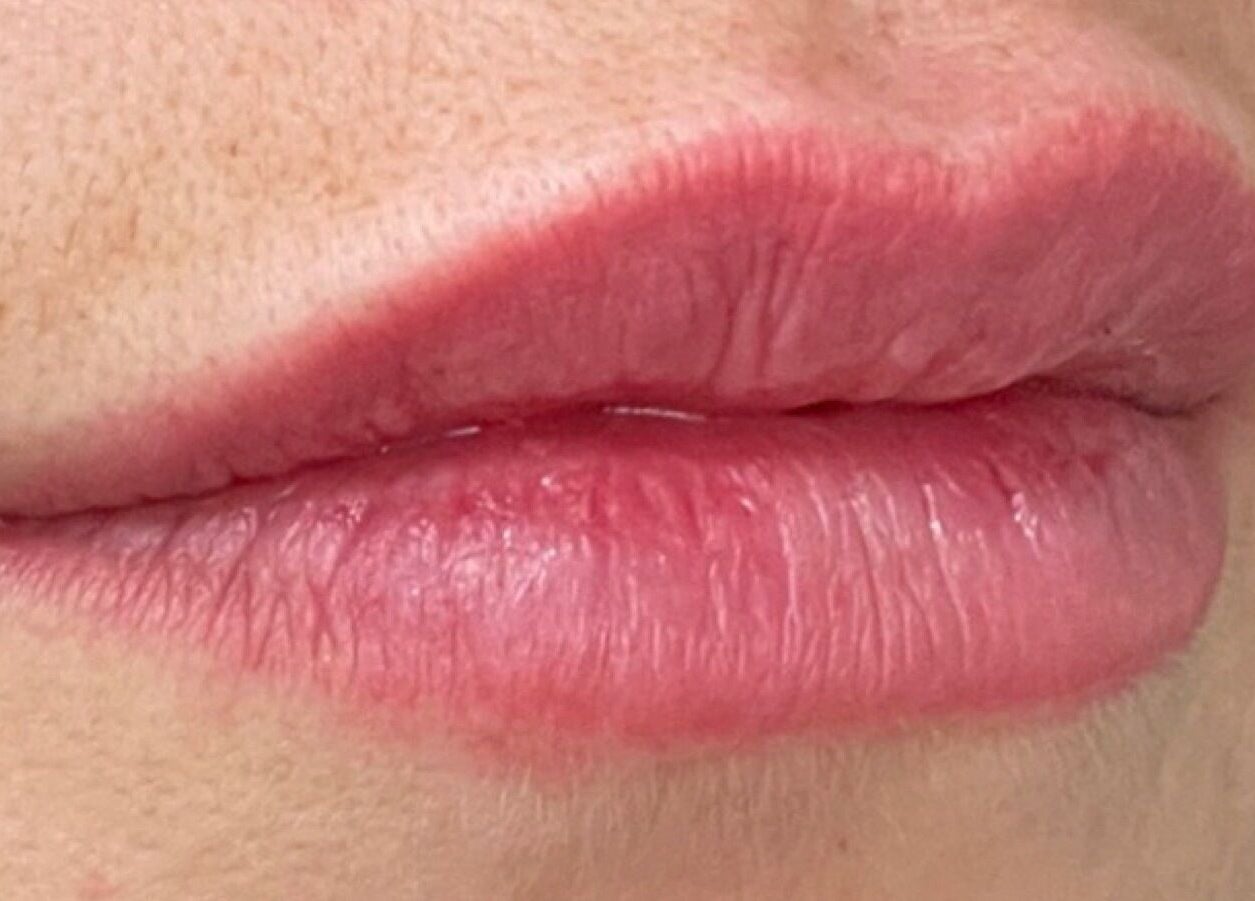 Close-up of lips after treatment at Oxley Aesthetics, Hemel Hempstead, England, GB.