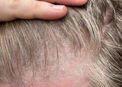 Close-up of Scalp SMP at Tiffany MacDonald - Permanent Make-Up, Weybridge, England, GB. Fine detail and realistic effect.