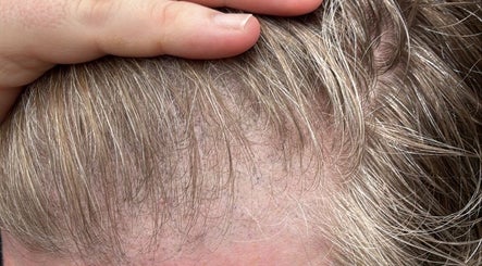 Close-up of Scalp SMP at Tiffany MacDonald - Permanent Make-Up, Weybridge, England, GB. Fine detail and realistic effect.