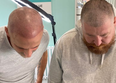 Scalp micropigmentation at Tiffany MacDonald - Permanent Make-Up, Weybridge, England, GB. Two clients, impressive results.
