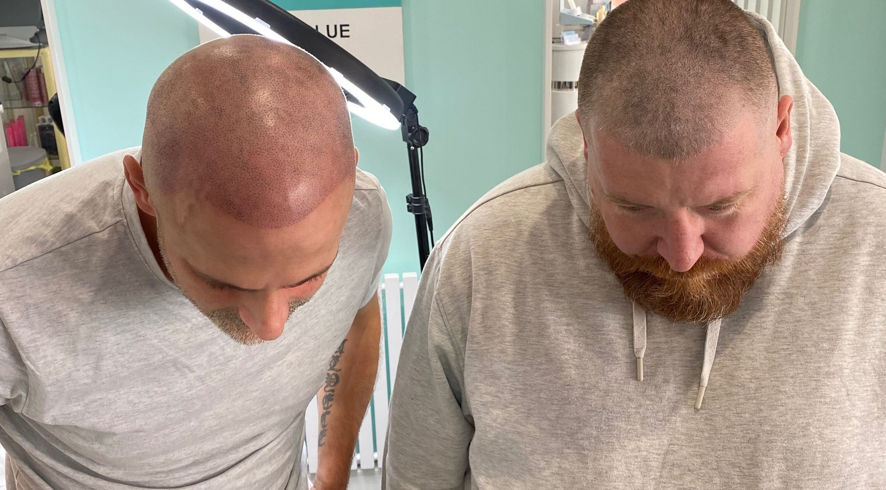 Scalp micropigmentation at Tiffany MacDonald - Permanent Make-Up in Weybridge, England, GB.