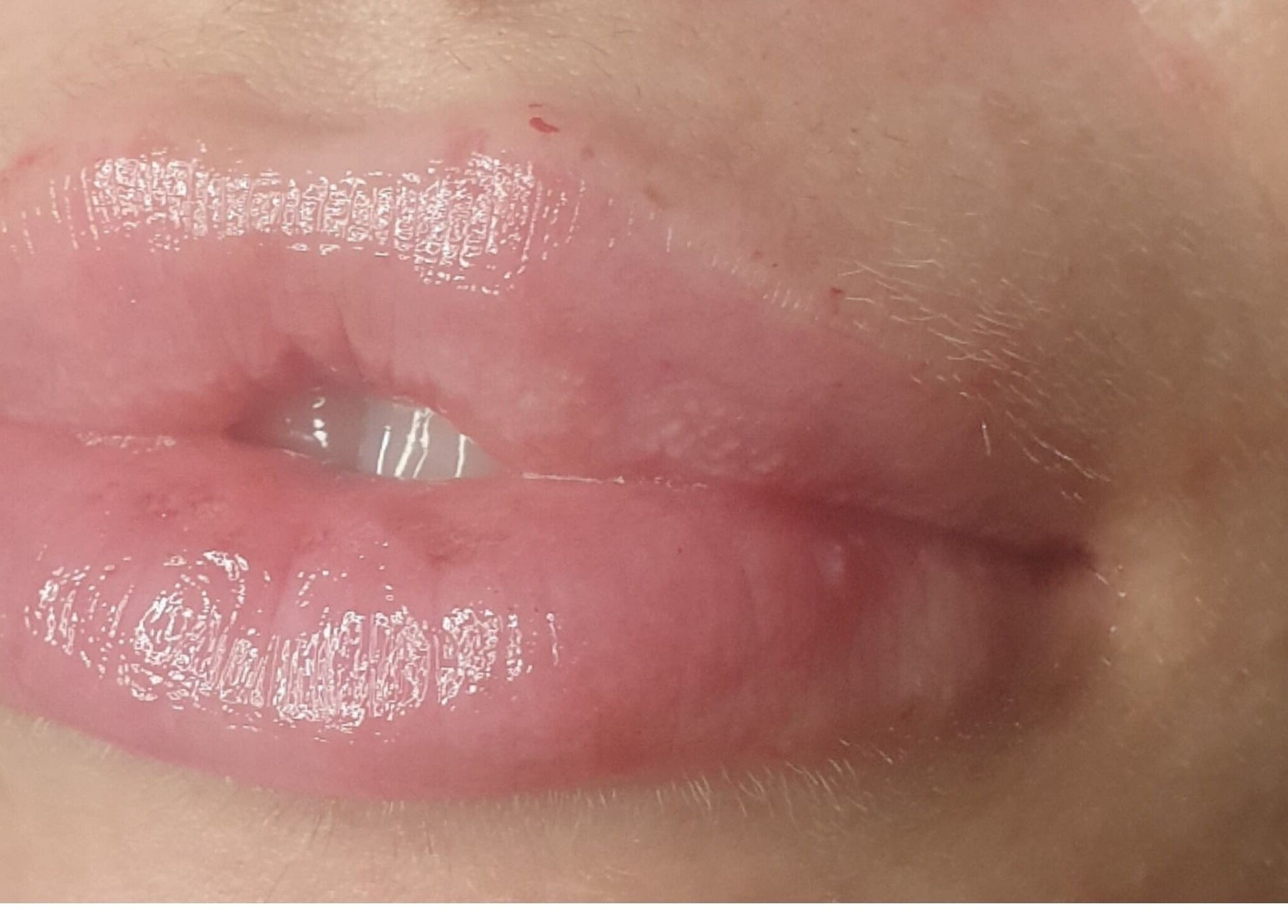 Lip enhancement at Desired Beauty, St Helens, England, GB, showcasing glossy and full lip finish.