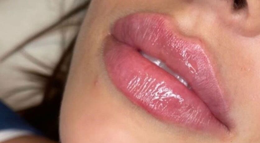 Close-up of glossy lips at YOU Aesthetics by Sofia, Caterham, England, GB.