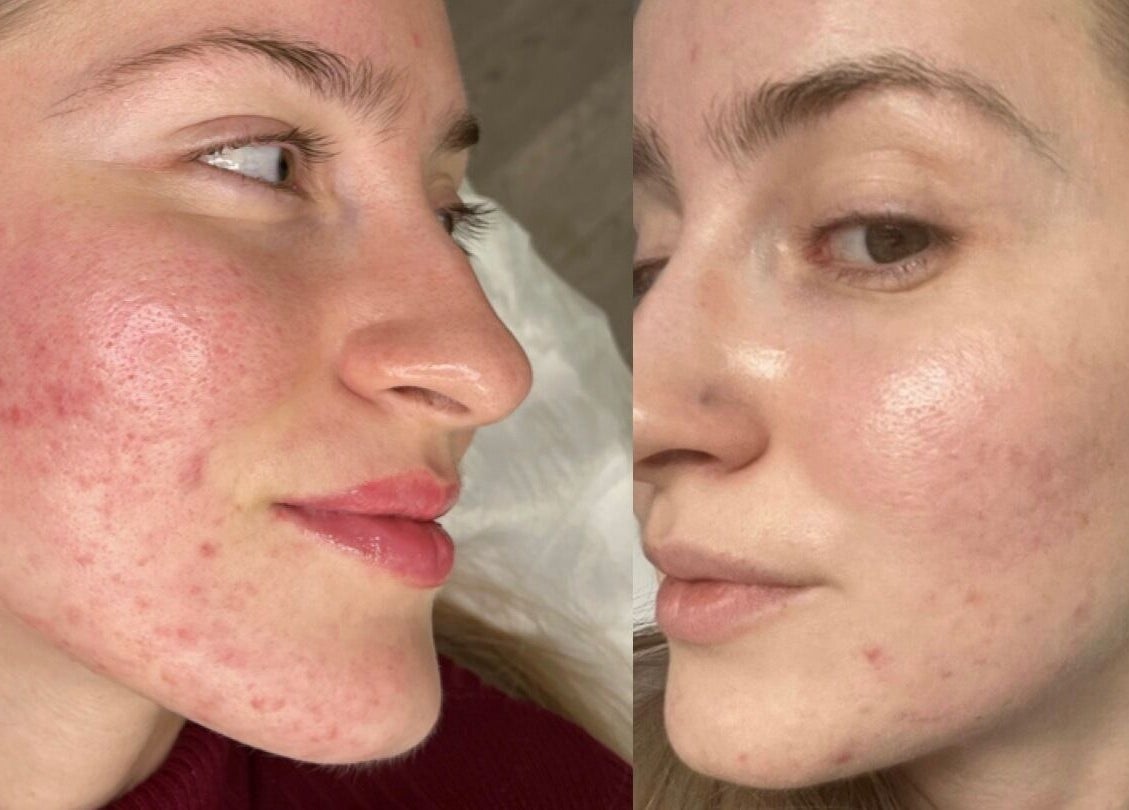 Before and after facial treatment at Beoti Aesthetics, Ashton-under-Lyne, England showcasing skin improvement.