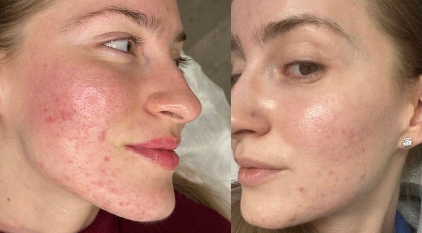 Before and after facial treatment at Beoti Aesthetics, Ashton-under-Lyne, England showcasing skin improvement.