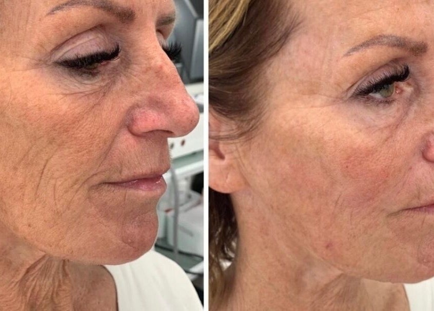 Before and after skin treatment at Beoti Aesthetics, Ashton-under-lyne, England, GB showing visible rejuvenation.