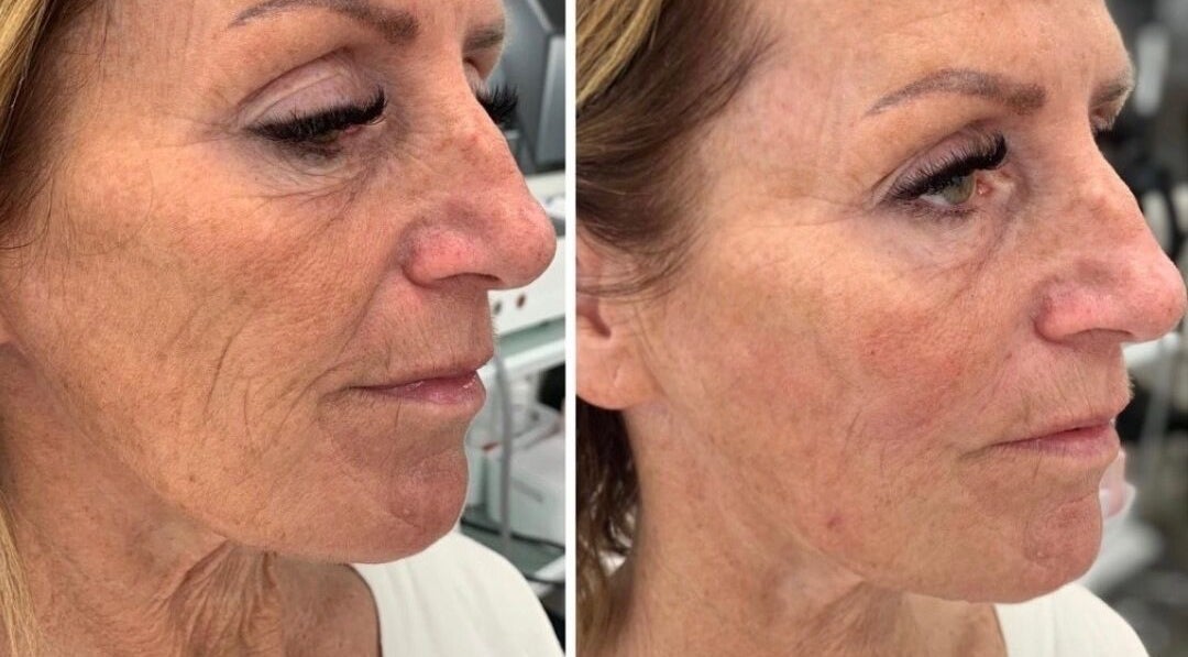 Before and after skin treatment at Beoti Aesthetics, Ashton-under-lyne, England, GB showing visible rejuvenation.