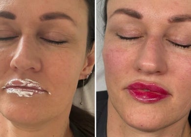 Lip enhancement procedure at Face Me Aesthetics, Arborfield Green, England shows before and after transformation.
