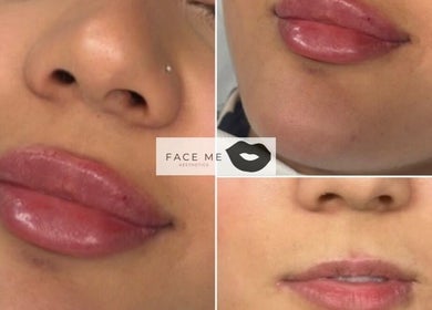 Enhance your beauty with lip treatments at Face Me Aesthetics, Arborfield Green, England, GB.