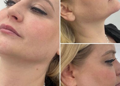 Profile and side facial views of a woman at Face Me Aesthetics, Arborfield Green, England, GB.