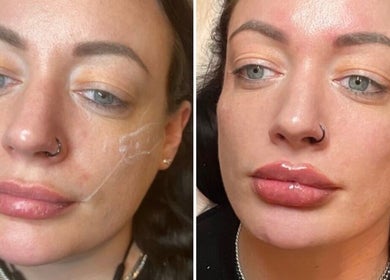 Before and after lip enhancement at Face Me Aesthetics, Arborfield Green, England, GB.