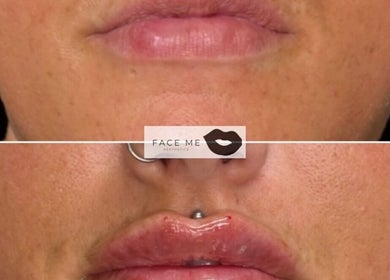 Lip enhancement before and after at Face Me Aesthetics, Arborfield Green, England, GB.
