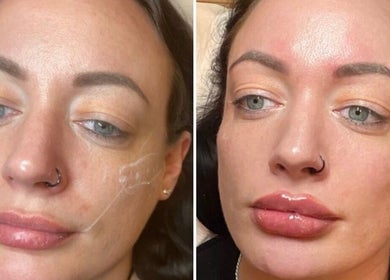 Before and after facial transformation at Face Me Aesthetics, Arborfield Green, England, GB.
