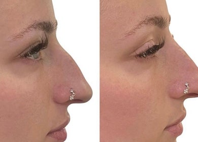 Before and after nose contouring at Face Me Aesthetics, Arborfield Green, England, GB.