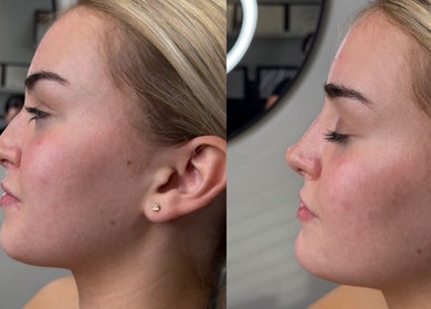 Profile view of facial treatment results at Beth Holden Aesthetics, Bamber Bridge, England, GB.