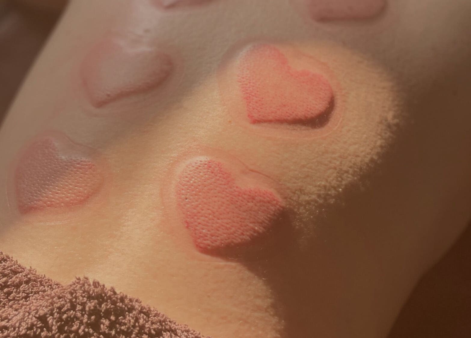 Heart-shaped cupping therapy marks at Integrative Bodywork, Massage & Somatic Therapy - Makia Mullen, Dublin, IE.