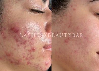 Before and after acne treatment at Lashesxbeautybar, Vaughan, Ontario, CA showcasing skin transformation.