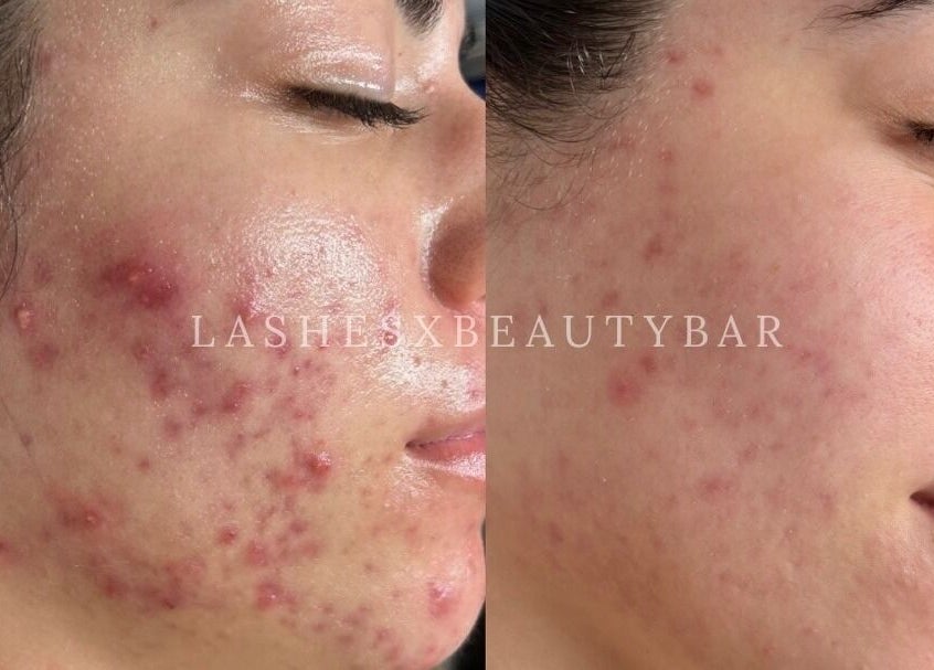 Before and after acne treatment at Lashesxbeautybar, Vaughan, Ontario, CA showcasing skin transformation.