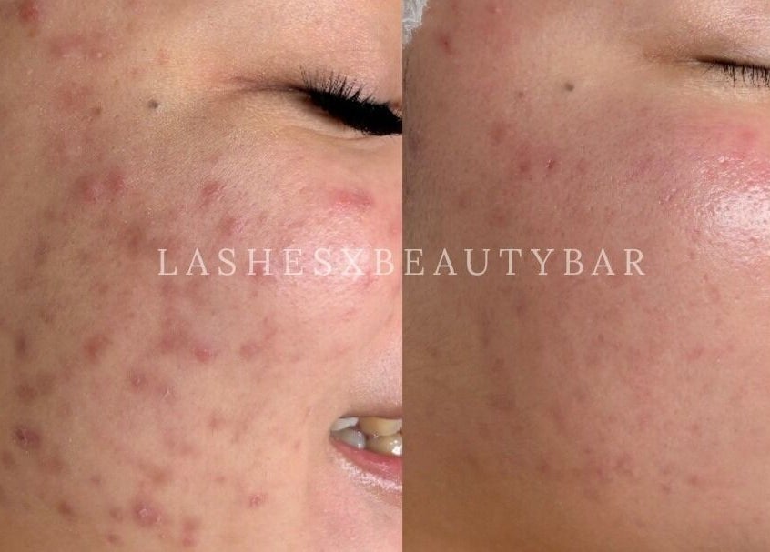 Before-and-after skin treatment at Lashesxbeautybar, Vaughan, Ontario, CA showing improved complexion.