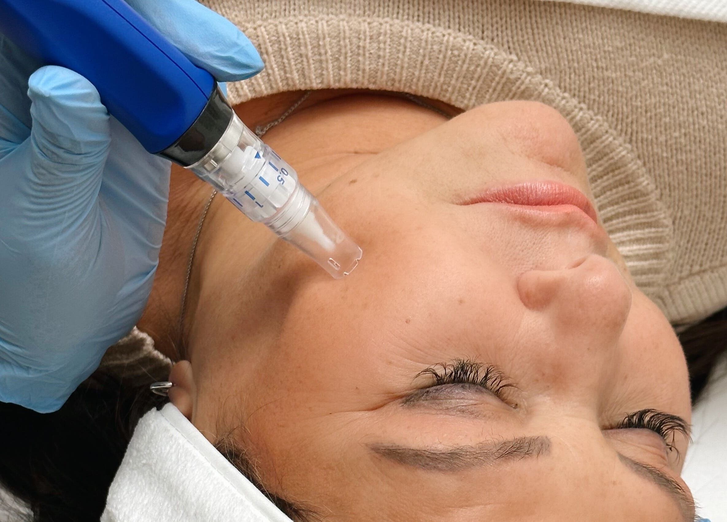 Microneedling treatment at The Good Skin Clinic, Peterborough, England, GB enhances skin rejuvenation.