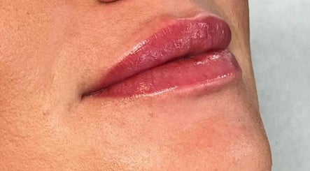 Glossy, well-defined lips enhanced at Discover Beauty London, Albany Park, Sidcup, located in Bexley, England, GB.