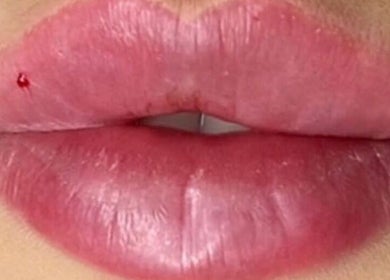 Close-up of lip enhancement at NS Skin Clinic, Hazel Grove, England, GB.
