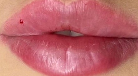 Close-up of lip enhancement at NS Skin Clinic, Hazel Grove, England, GB.