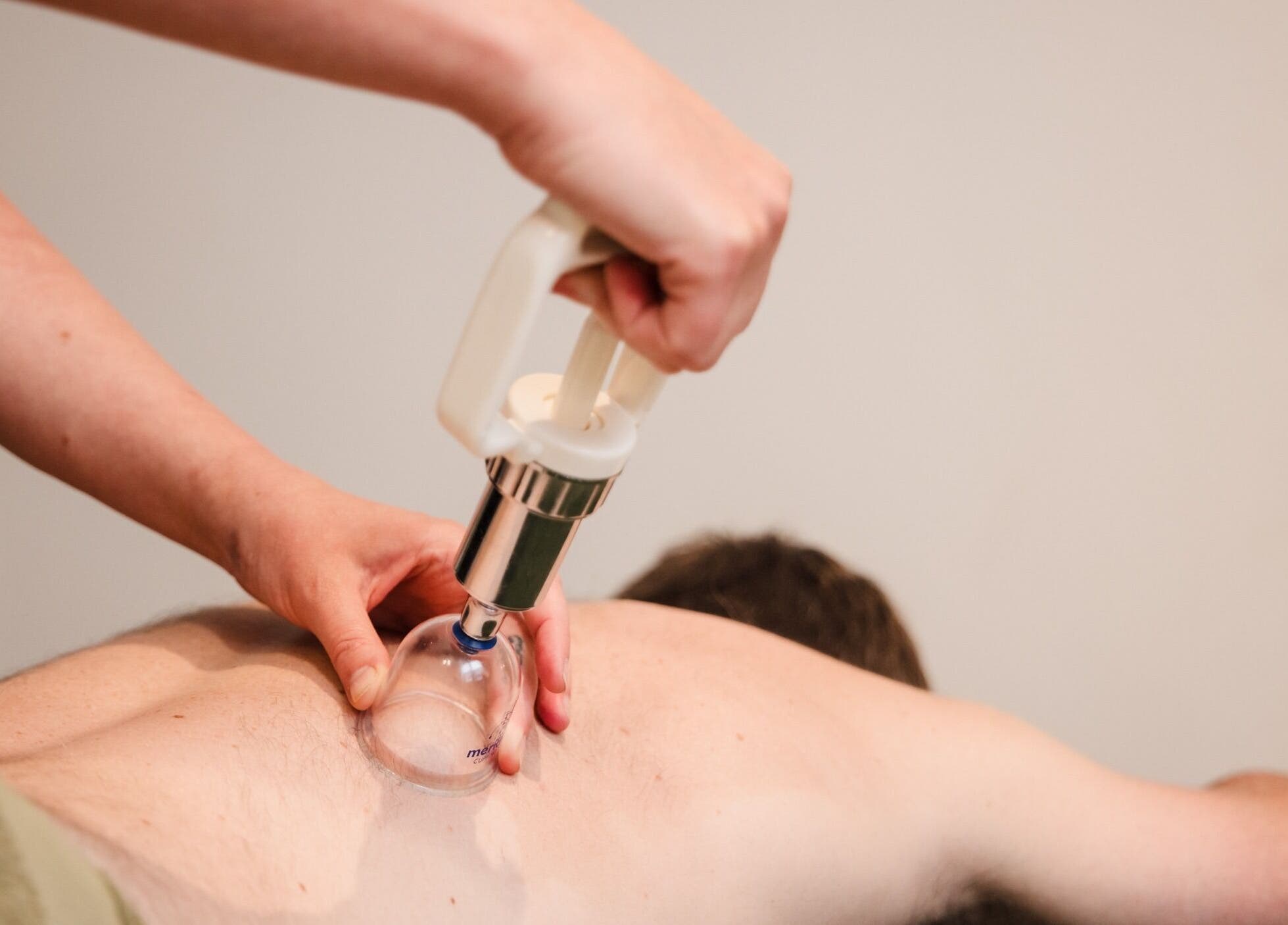 Cupping therapy at Bloom Well Being in Newcastle upon Tyne, England, GB, enhancing relaxation and wellness.