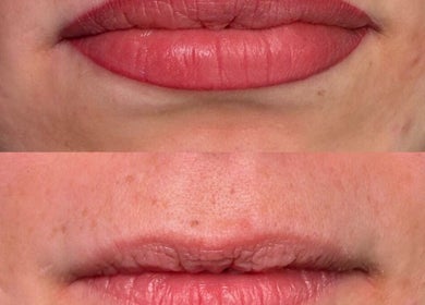 Before and after lip enhancement at Keep It Cassie, Hucclecote, England, GB.
