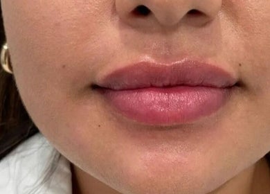 Enhanced lips after treatment at Fillersldn Gravesend, located in Gravesend, England, GB.