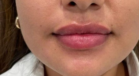 Enhanced lips after treatment at Fillersldn Gravesend, located in Gravesend, England, GB.