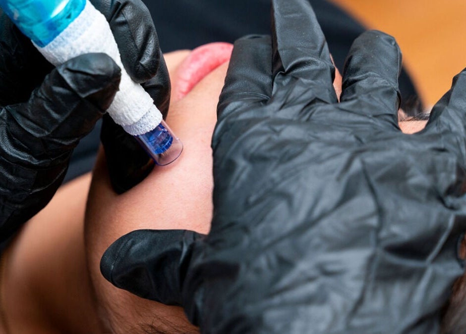 Microneedling treatment at Rose Clinic, North Perth, Western Australia, AU enhancing skin rejuvenation.