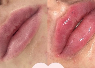 Before and after lip enhancement at Glamology UK, Rossendale, England, GB showcasing volumized results.