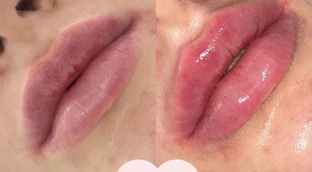 Before and after lip enhancement at Glamology UK, Rossendale, England, GB showcasing volumized results.