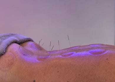 Acupuncture and cupping therapy at JP Sports Massage in Stockport, England, GB.