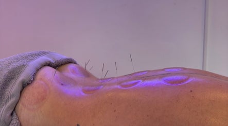 Acupuncture and cupping therapy at JP Sports Massage in Stockport, England, GB.