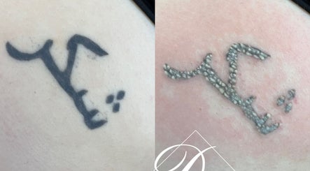 Tattoo removal progress at Durban Designer Brows SA, Durban North, Kwazulu-natal, ZA.