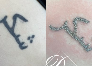 Tattoo removal service at Durban Designer Brows SA in Umhlanga, Kwazulu-natal, ZA showcasing before and after results.