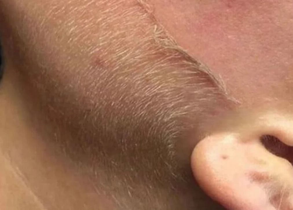 Dermaplaning treatment at Her.Byron Bay in Suffolk Park, New South Wales, AU offering smooth skin results.