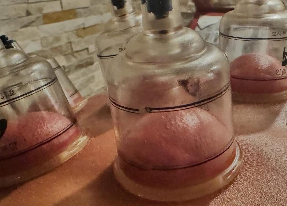 Cupping therapy at Edelweiss Day Spa in Kosciuszko National Park, New South Wales, AU promotes relaxation.